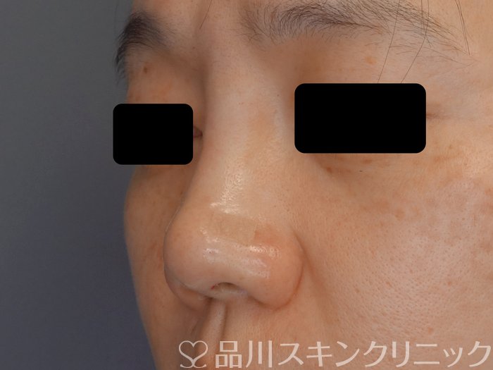 症例NO.72366のAFTER写真