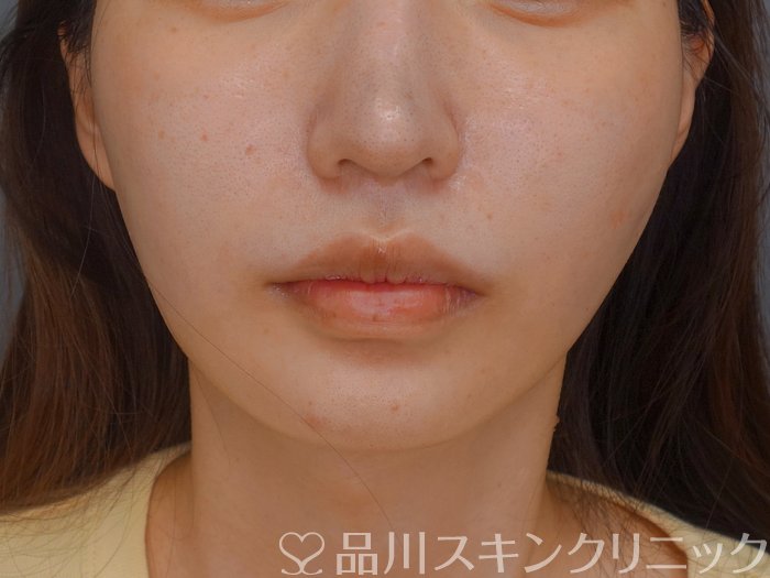 症例NO.73786のAFTER写真