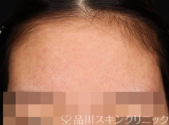 症例NO.72178のAFTER写真