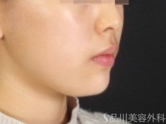 症例NO.72533のAFTER写真