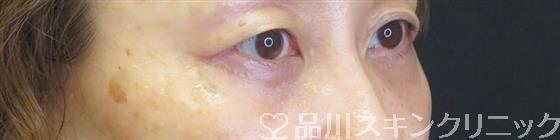 症例NO.61397のAFTER写真