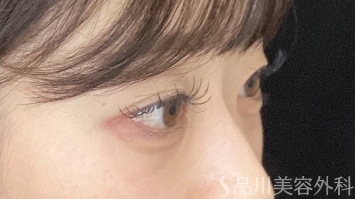 症例NO.72005のAFTER写真