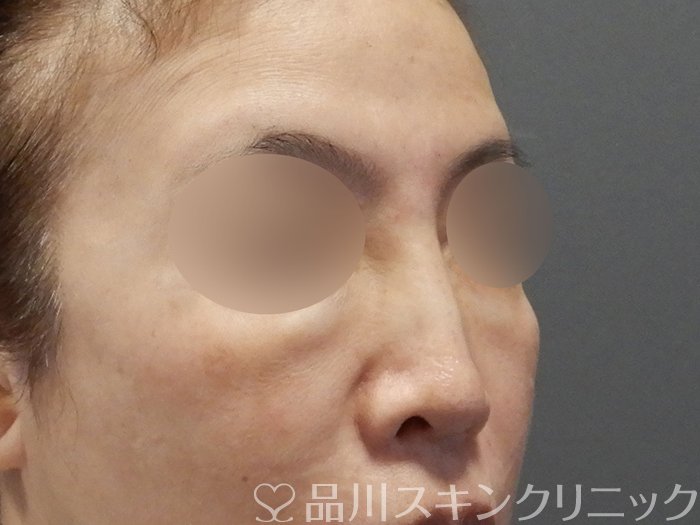 症例NO.75044のBEFORE写真