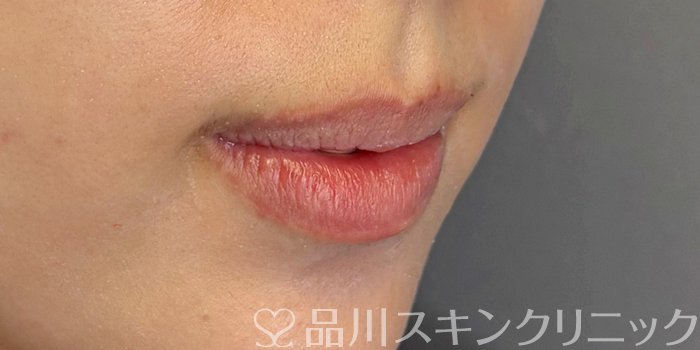 症例NO.71732のBEFORE写真