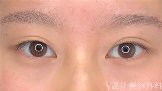 症例NO.59548のBEFORE写真