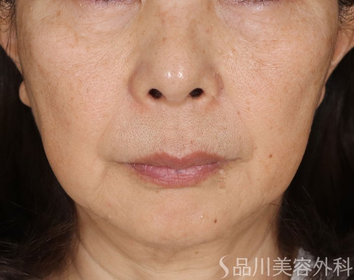 症例NO.73517のBEFORE写真