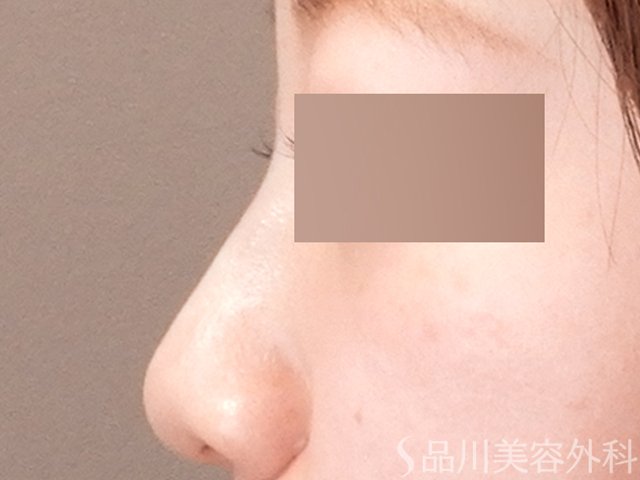 症例NO.70723のAFTER写真
