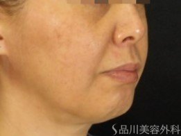 症例NO.70996のBEFORE写真