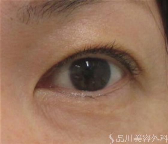 症例NO.23203のAFTER写真