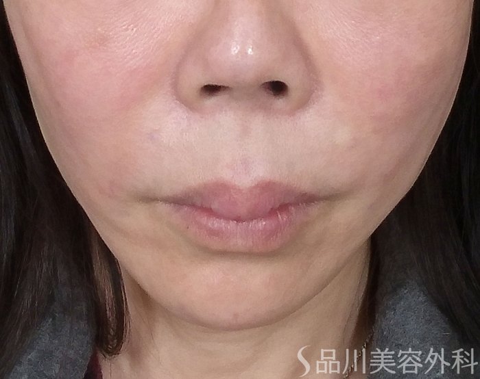 症例NO.69891のAFTER写真