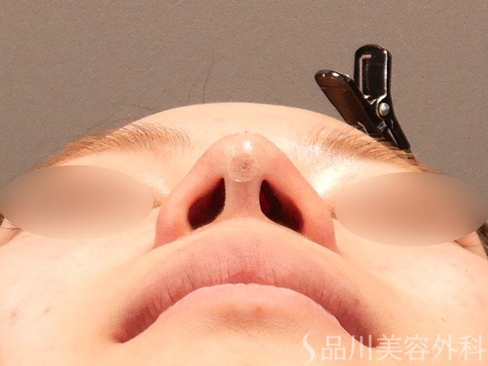 症例NO.70794のAFTER写真