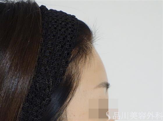 症例NO.49464のAFTER写真