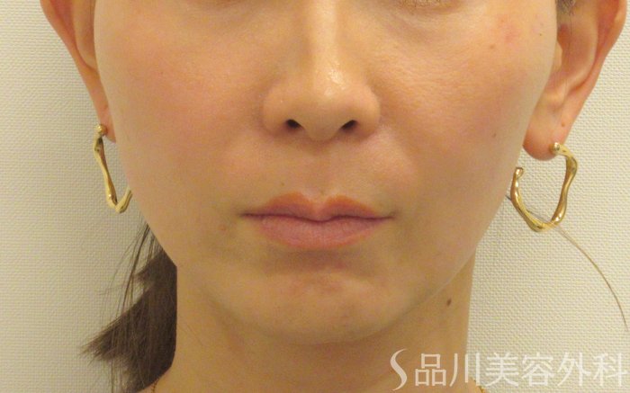 症例NO.72956のAFTER写真