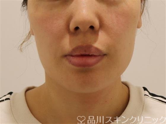 症例NO.44242のBEFORE写真