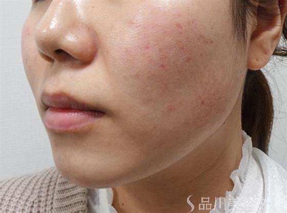 症例NO.51262のBEFORE写真
