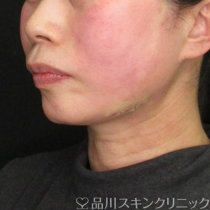症例NO.69777のAFTER写真
