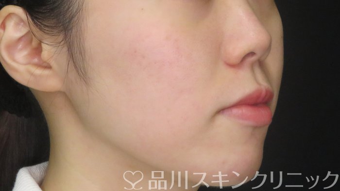 症例NO.71428のAFTER写真
