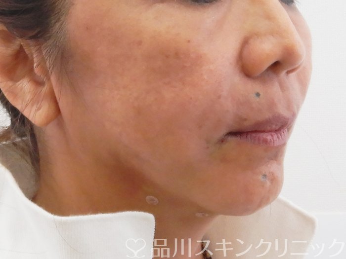 症例NO.63732のAFTER写真