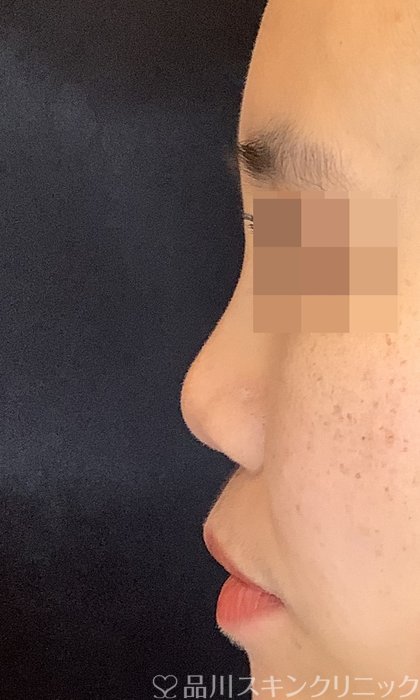 症例NO.69986のAFTER写真