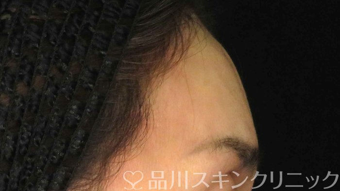 症例NO.71611のAFTER写真