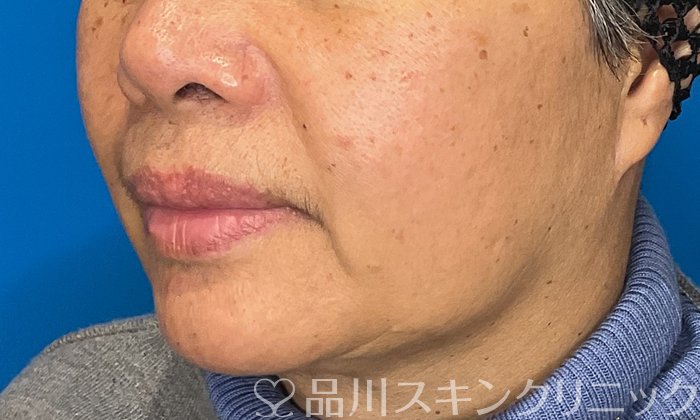 症例NO.74512のBEFORE写真