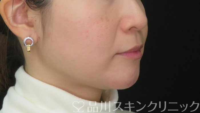 症例NO.72294のBEFORE写真