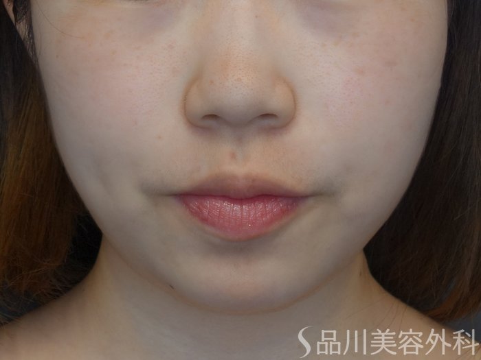 症例NO.73909のAFTER写真