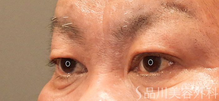 症例NO.69470のBEFORE写真