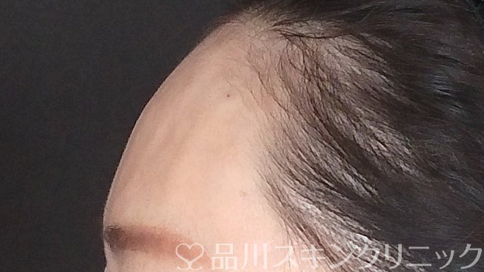 症例NO.71743のAFTER写真