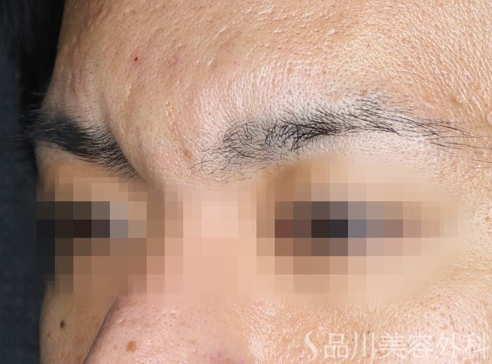 症例NO.73693のAFTER写真