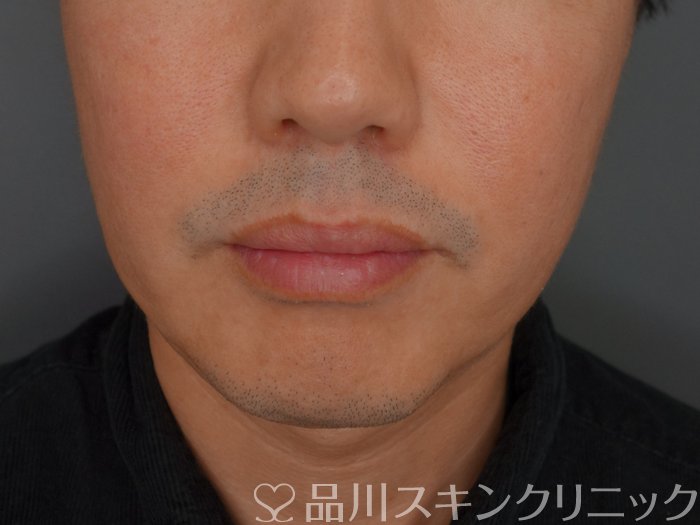 症例NO.75309のBEFORE写真