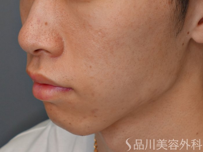 症例NO.73514のBEFORE写真