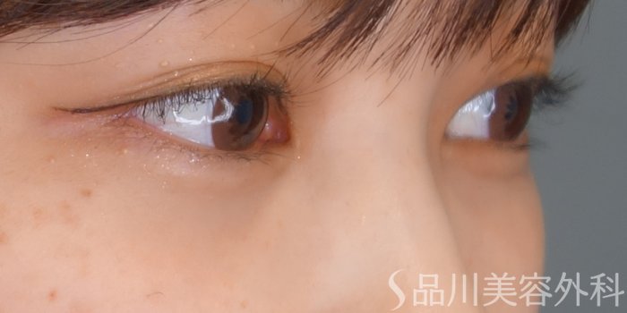 症例NO.69751のAFTER写真