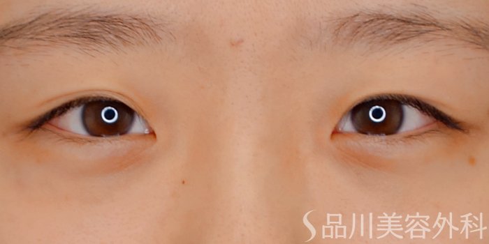 症例NO.69845のBEFORE写真