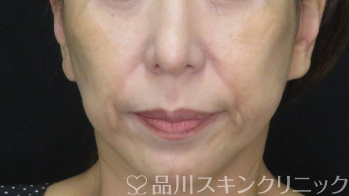 症例NO.72064のBEFORE写真