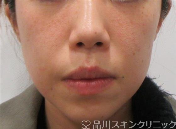 症例NO.26725のAFTER写真