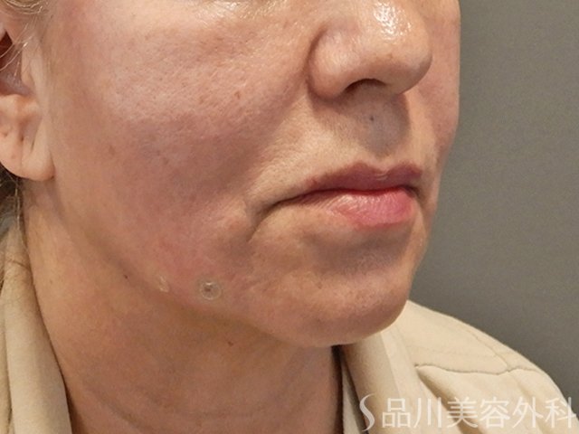 症例NO.72959のAFTER写真