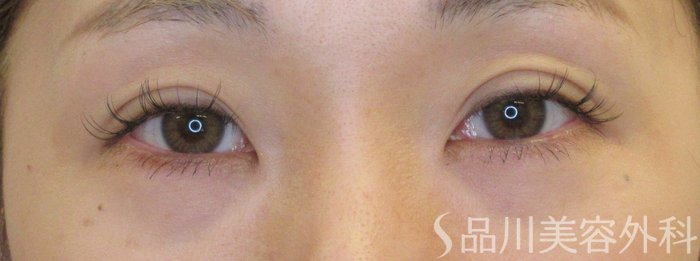 症例NO.70910のAFTER写真