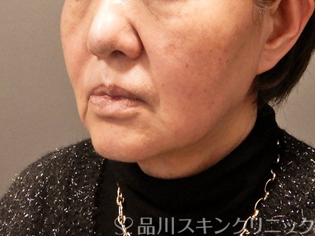 症例NO.69432のBEFORE写真