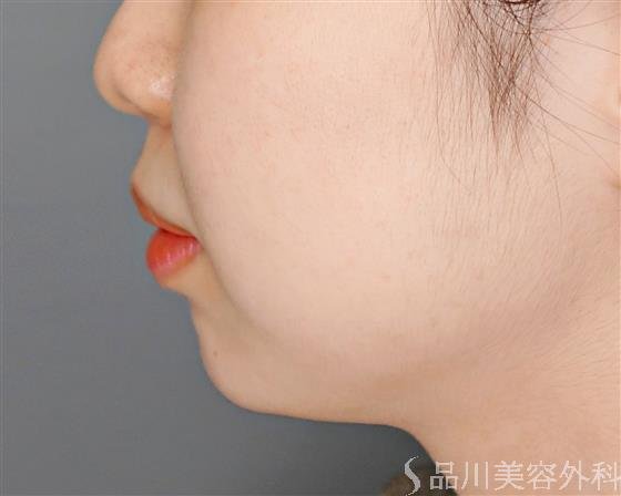 症例NO.52958のAFTER写真