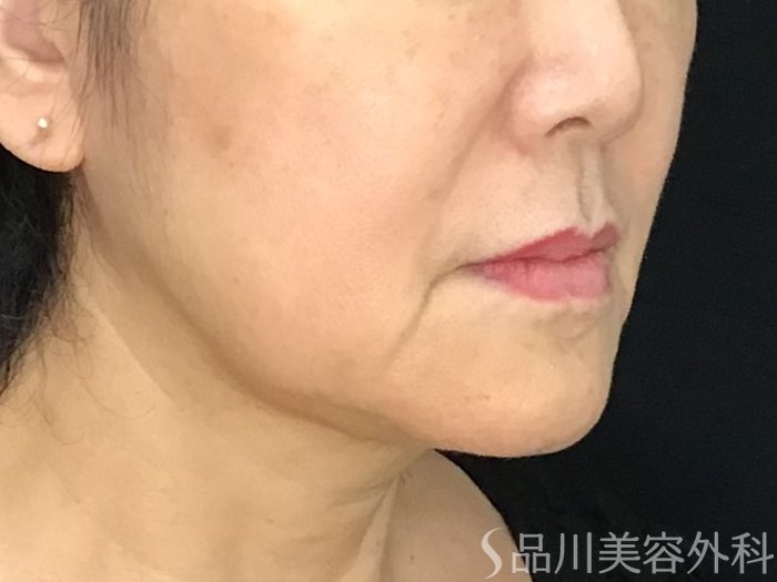 症例NO.71596のBEFORE写真