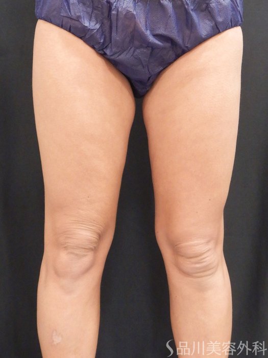 症例NO.75201のBEFORE写真