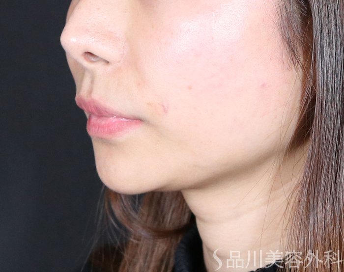 症例NO.73142のAFTER写真