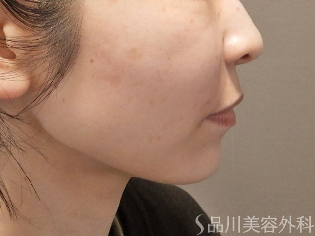症例NO.74340のAFTER写真