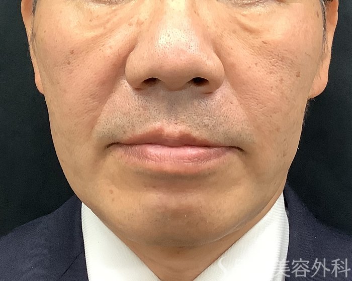 症例NO.69643のAFTER写真