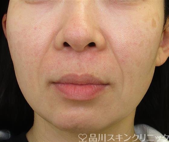症例NO.57920のBEFORE写真