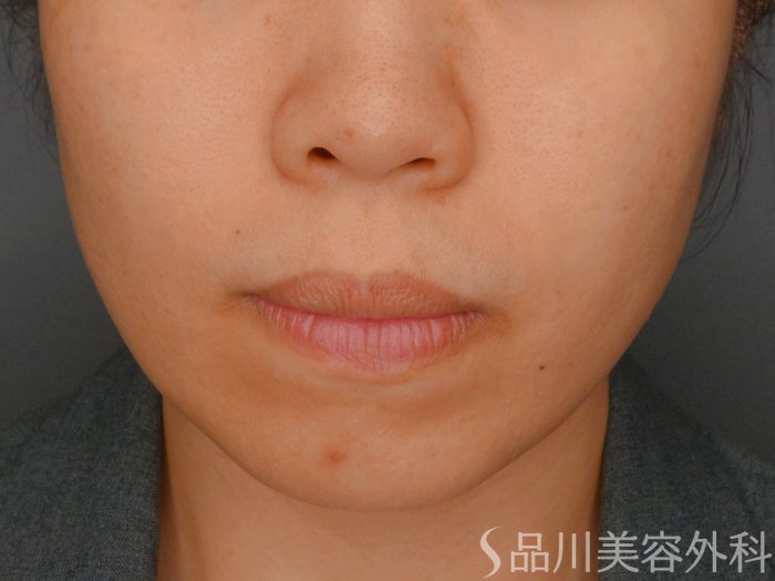 症例NO.73492のBEFORE写真