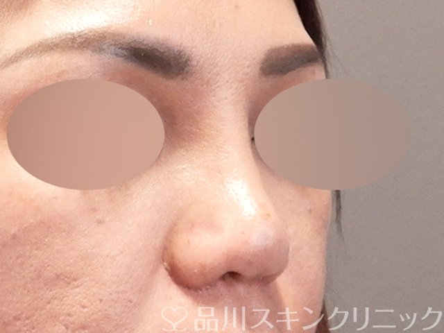 症例NO.67918のAFTER写真