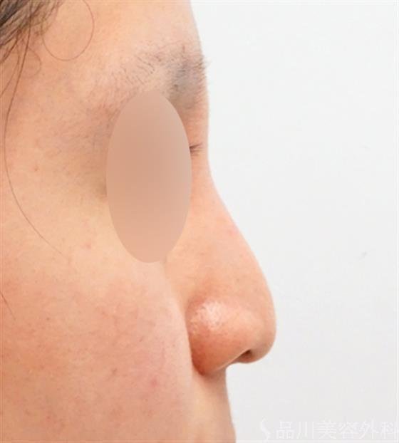症例NO.51339のBEFORE写真
