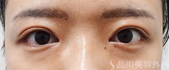 症例NO.54017のAFTER写真